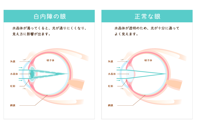 白内障の眼と正常な眼の説明図