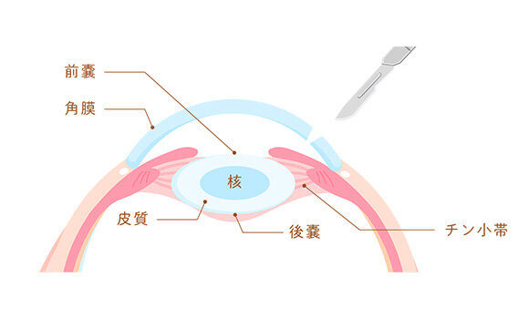 白内障手術のイメージ図
