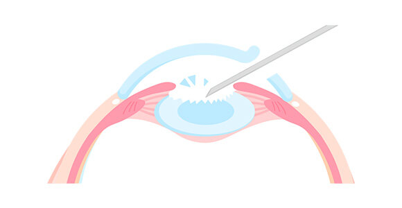 白内障手術のイメージ図