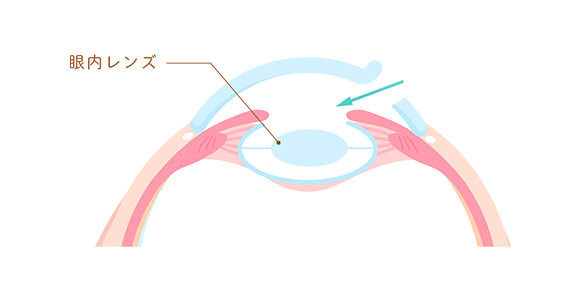 白内障手術のイメージ図